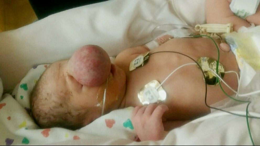 PHOTO: Zakary Riegel was born with a congenital bony defect in his skull.