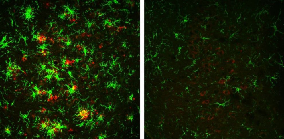 PHOTO: At left, the brain of a mouse with Alzheimers disease full of amyloid plaques shown in red, surrounded by activated microglial cells, in green. These indicators are reversed in animals that have gradually lost the BACE1 enzyme, shown at right.