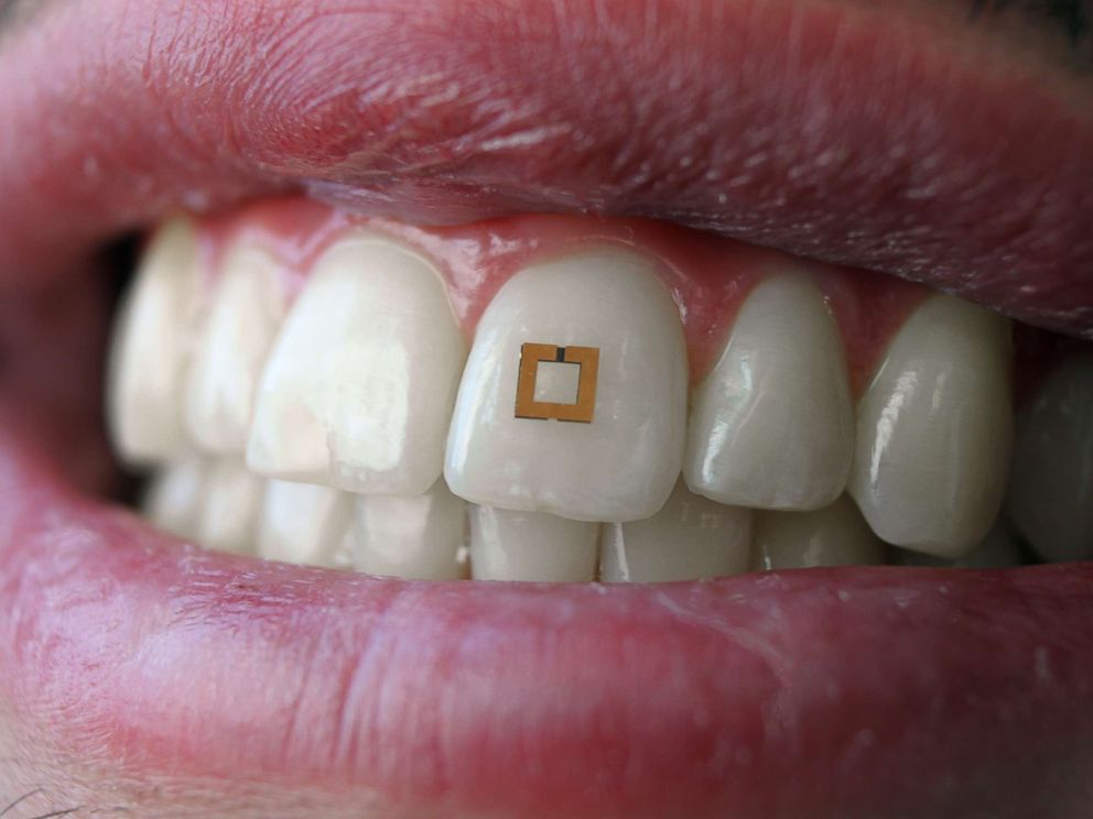 PHOTO: Researchers at Tufts University are experimenting with sensors attached to human teeth that might be able to monitor food and caloric intake and send signals to nearby devices.